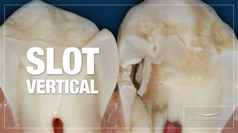 slot vertical dentística